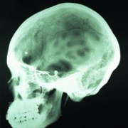 Anoxic Brain Injury related image